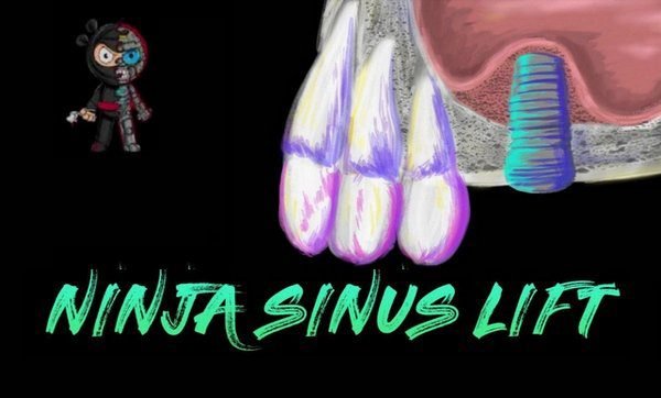 <font style="vertical-align: inherit;"><font style="vertical-align: inherit;">
	
	Cours Ninja Sinus Lift
	</font></font>