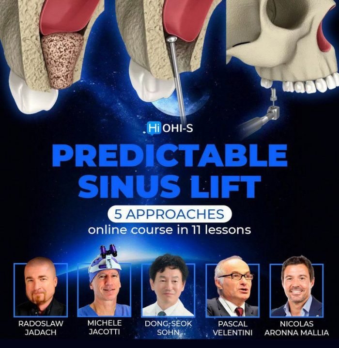 <font style="vertical-align: inherit;"><font style="vertical-align: inherit;">
	
	Cours prévisible de lifting des sinus
	</font></font>